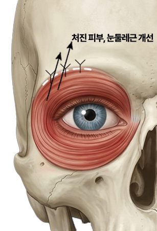 처진 피부, 눈둘레근 개선