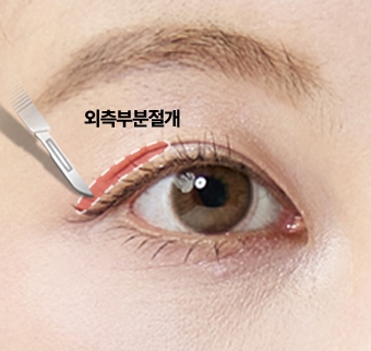 외측부분절개