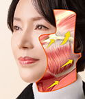 안면거상