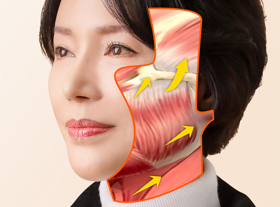 안면거상