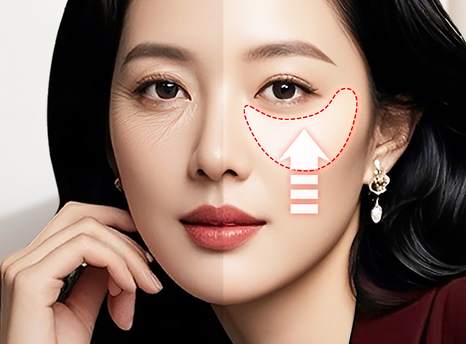 나비하안검