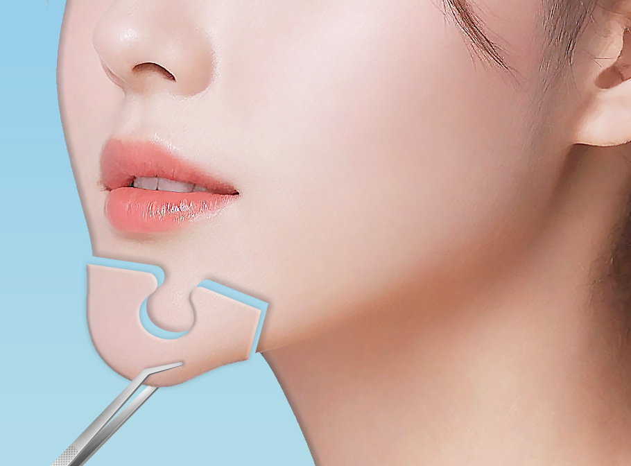마녀턱수술술